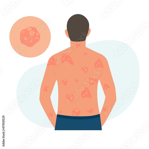 The man has alergic itching, skin inflammation, redness and irritation. Pustular psoriasis.Atopic dermatitis, eczema, psoriasis, dry skin. Skin problems Concept, isolated, vector. photo