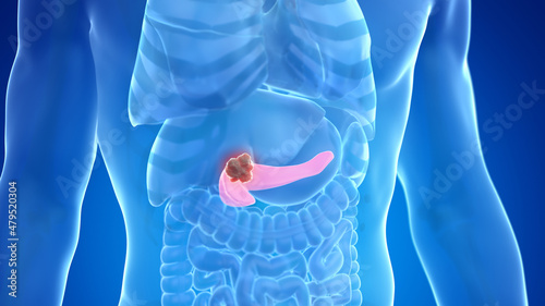 3d rendered medically accurate illustration of pancreas cancer photo