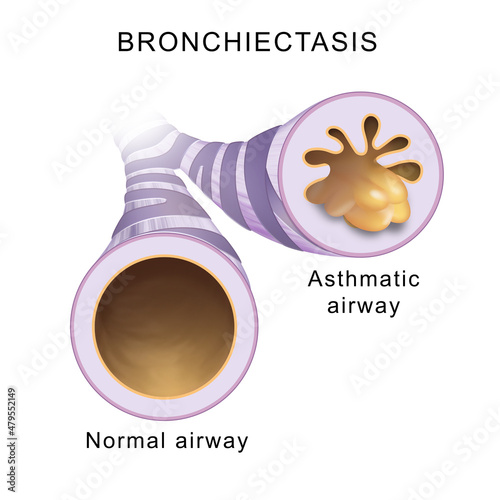 Bronchiectasis. Normal airway and asthmatic airway photo