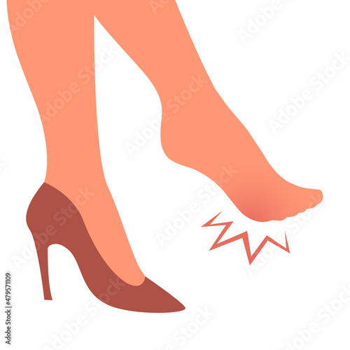 A woman leg with a sore callus. Transverse flat feet. Orthopedic disease. Foot health problems. High heels. Vector isolated illustration