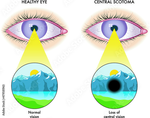 Medical illustration of the symptoms of central scotoma.