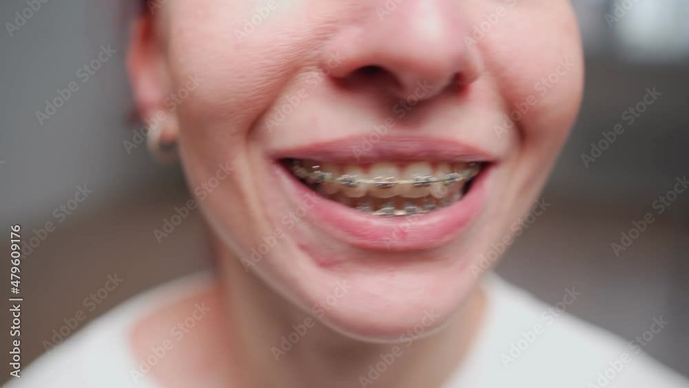 Close-up. Woman smiling showing braces. Dental treatment and teeth alignment concept. Close-up. Woman smiling showing braces. Dental treatment and teeth alignment concept.