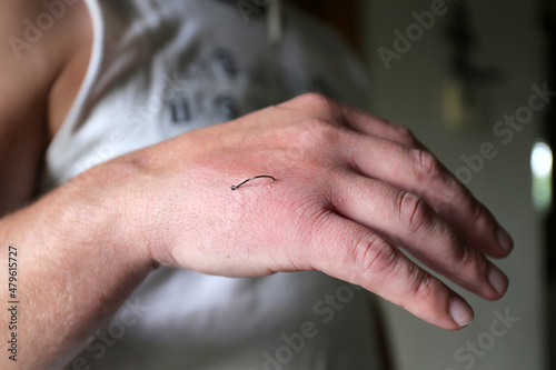Canvas Print Fish Hook Embedded into skin of Man's Hand