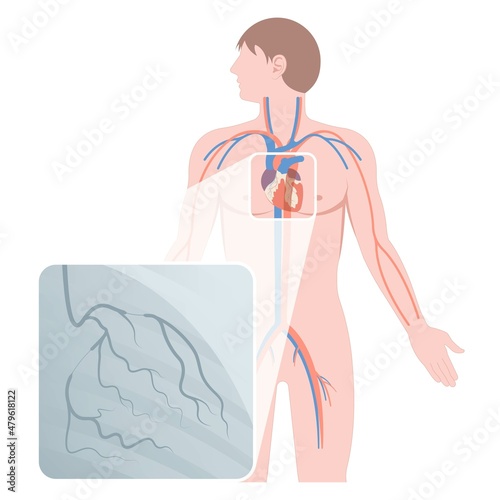 Angiography medical operation Angiogram Biopsy Angioplasty Stent Congenital Heart Defect Ablation CAG arteries plaque X-ray flow diagnose diagnosis blocked CABG valve atrial attack afib infarction