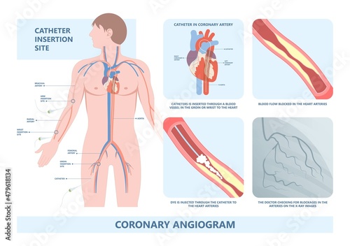 Angiography medical operation Angiogram Biopsy Angioplasty Stent Congenital Heart Defect Ablation CAG arteries plaque X-ray flow diagnose diagnosis blocked CABG valve atrial attack afib infarction