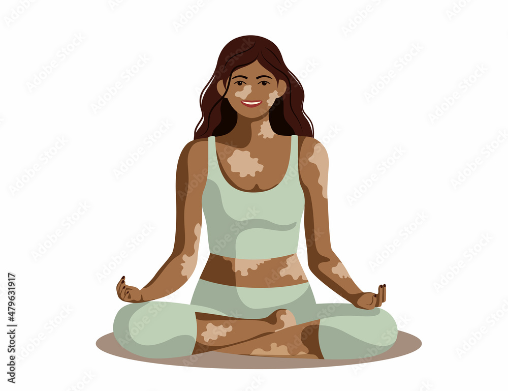 Woman with vitiligo in lotus pose smiling. Love Your Body body-positive banner concept