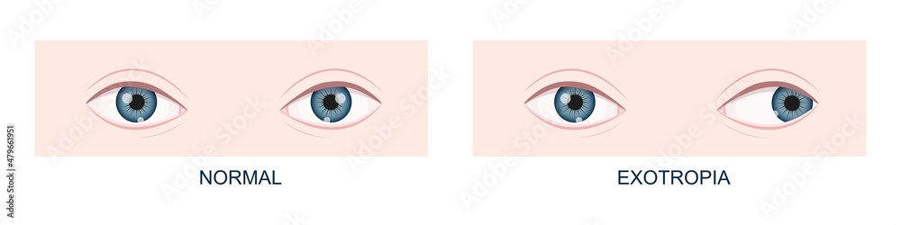 Exotropia. Horizontal strabismus before and after surgery. Eye ...