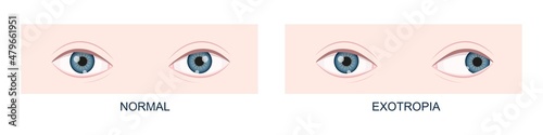 Exotropia. Horizontal strabismus before and after surgery. Eye misalignment, cross-eyed condition. Human eyes healthy and with outward gaze position. Double vision. Vector cartoon illustration