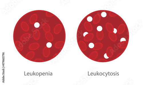 Leukocytosis and leukopenia illustration in a sample of blood. Blood disorder in the White blood cells concentration photo
