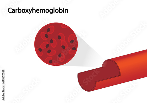 Carboxihemoglobin representation in a blood vessel