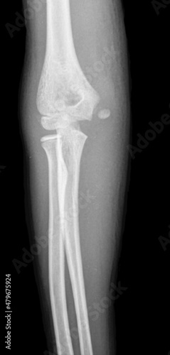 x ray image  of medial epicondyle fracture , an avulsion injury of the attachment of the common flexors of the forearm photo
