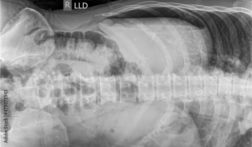 x ray image of pneumoperitoneum ,intra abdominal organ perforation