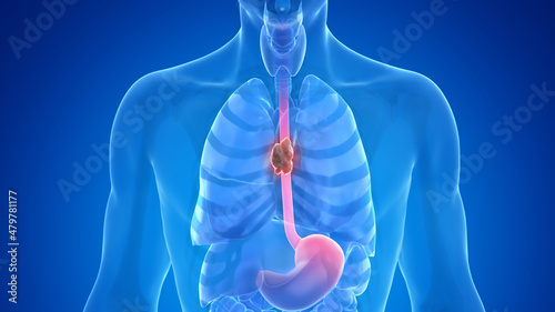 3d rendered medically accurate illustration of esophagus cancer