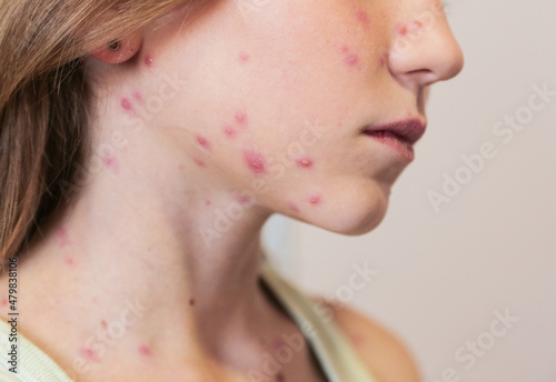 Cute little girl with chickenpox at home. Varicella zoster virus.