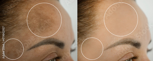 woman forehead pigmentation before and after treatment photo