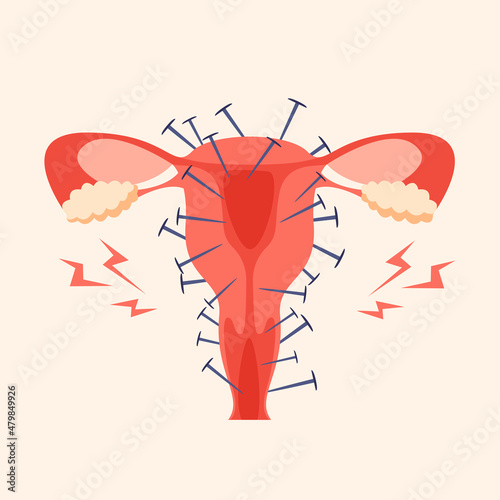 Painful menstruation concept trendy flat illustration. Uterus inflammation, endometriosis,  banner design. Cancer symptom, cycle problems, pms background.