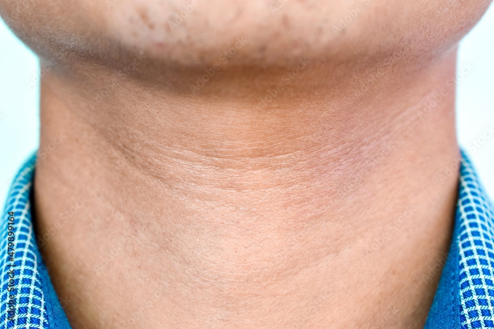 Aging skin folds or creases or wrinkles at neck of Asian young man. Aging skin folds or creases or wrinkles at neck of Asian young man.