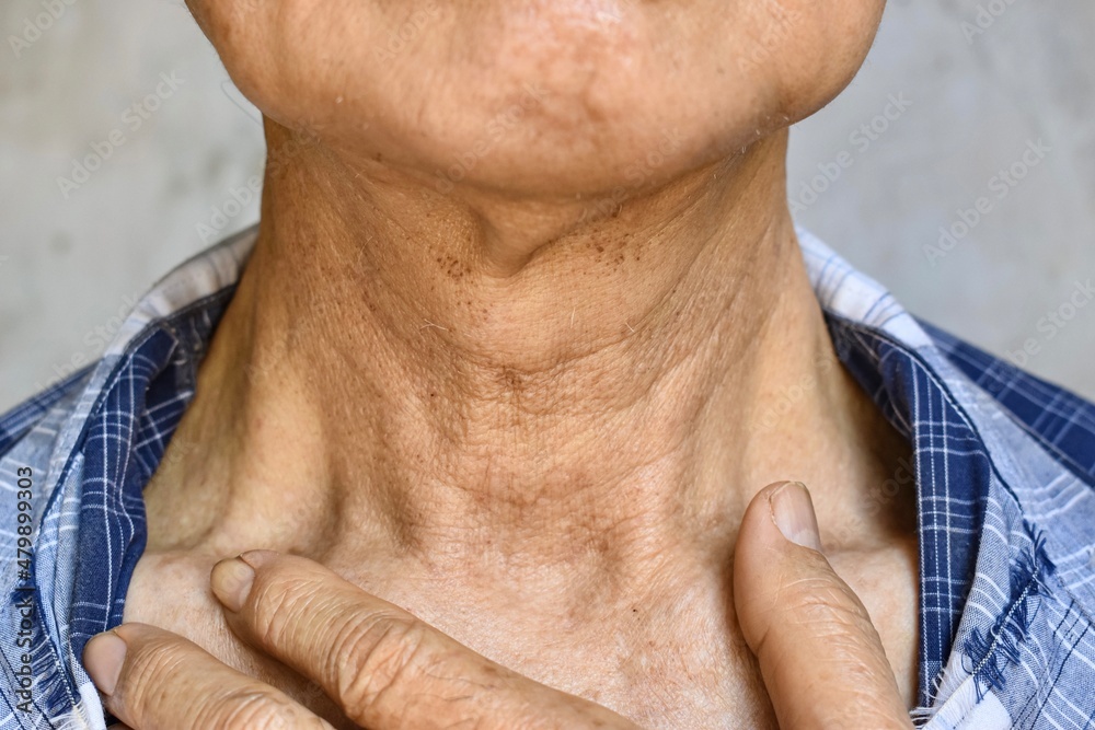 Fototapeta premium Aging skin folds or skin creases or wrinkles at neck of Asian old man. Concept of sore throat.