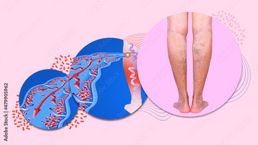 Varicose veins on a female senior legs. The structure of normal and varicose veins. Varicose veins on a female senior legs. The structure of normal and varicose veins.
