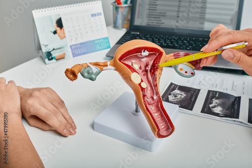Gynecologist showing polyps of endometrium of uterus using anatomical model during consultation to female patient. Gynecology, treatment of uterine polyps photo