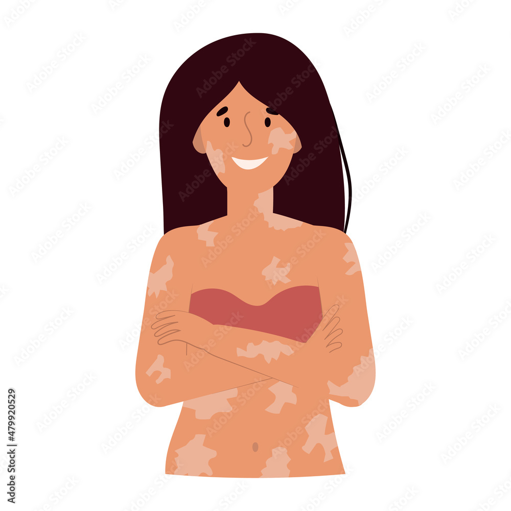 Smiling woman with vitiligo portrait. World vitiligo day. Self care, self love, body positive. Vector flat illustration. Smiling woman with vitiligo portrait. World vitiligo day. Self care, self love, body positive. Vector flat illustration.