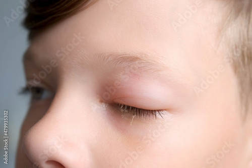 Fotografie, Obraz Face of boy with a swollen eye from an insect bite, closeup view