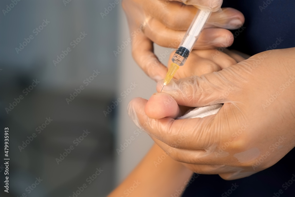 Surgeon gives injection of local anesthesia to teen boy patient during laser surgery removing wart on thumb finger, closeup view. One day surgery concept. Sore and wound after operation. Surgeon gives injection of local anesthesia to teen boy patient during laser surgery removing wart on thumb finger, closeup view. One day surgery concept. Sore and wound after operation.