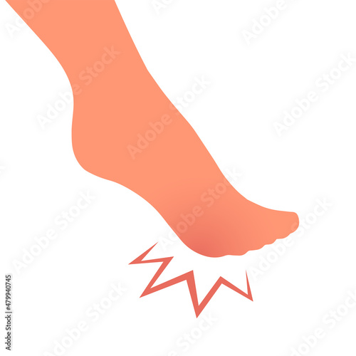 A woman leg with a sore callus. Transverse flat feet. Orthopedic disease. Foot health problems. Vector isolated illustration