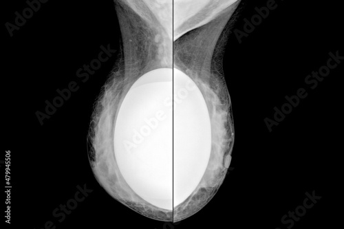 Comparative mammogram in middle-lateral projection.of a patient for the control of breast implants