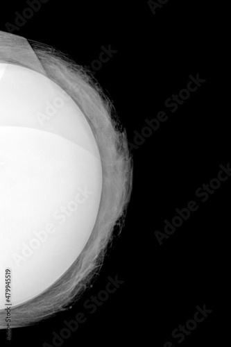 Mammography in caudal-skull projection of a left breast for the breast implants check