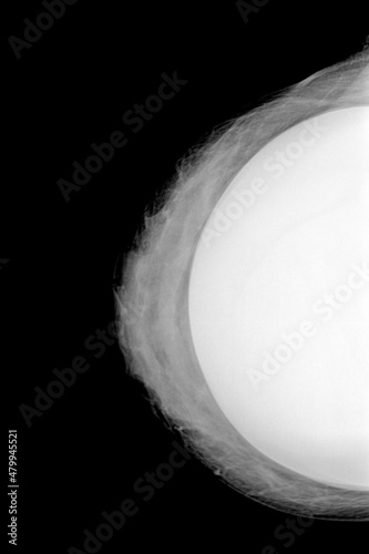 Mammography in caudal-skull projection of a right breast for the breast implants check