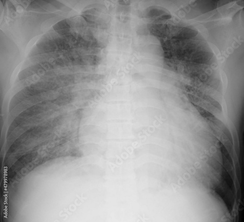 x ray image of pulmonary edema and cardiomyopathy photo