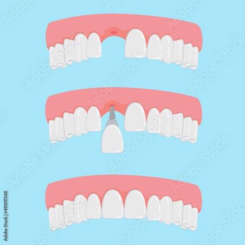 Vector  Teeth with Implant Closeup Isolated on White Background. Dentistry and Orthodontics Design. Human Teeth for Medical Prosthetics Concept
