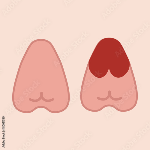 Menstruation hygiene. Female period products -tampon, tampon with menstrual blood . Feminine menstrual care illustration. Menstrual period. Feminism. Gender equality. Vector graphics