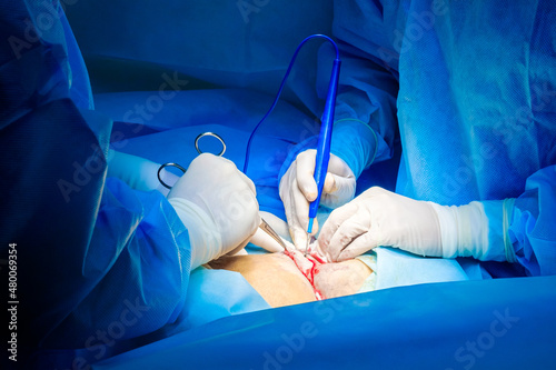 Selective focus on hands of surgeons wearing sterile gloves during surgery. Doctors cut the patient's skin with an electric coagulator.