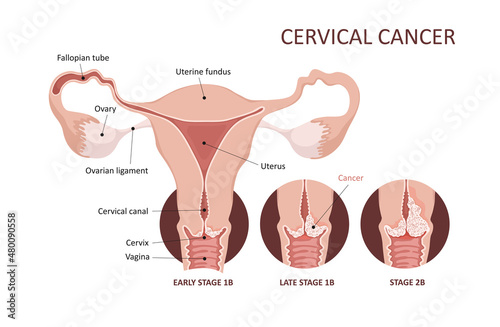 Cervical cancer development image. Cervix carcinoma stages. Female reproductive system. Anatomy. Gynecology.