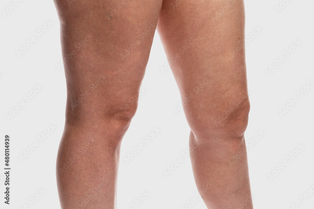 Thick female legs with cellulite and varicose veins. Overweight and disease. Close-up. Isolated on a light gray background. Thick female legs with cellulite and varicose veins. Overweight and disease. Close-up. Isolated on a light gray background.