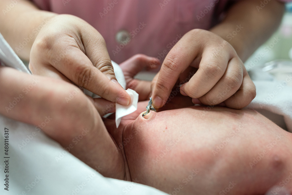 A nurse is cleaning the umbilical cord of newborn baby. Health care and medical action photo. Close-up and selective focus. - obrazy, fototapety, plakaty 
