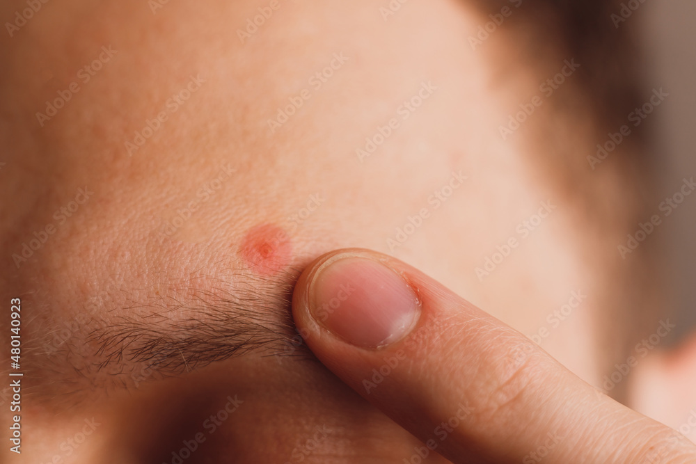 Pimple on the man's forehead above eyebrow. Designated by color close-up Pimple on the man's forehead above eyebrow. Designated by color close-up