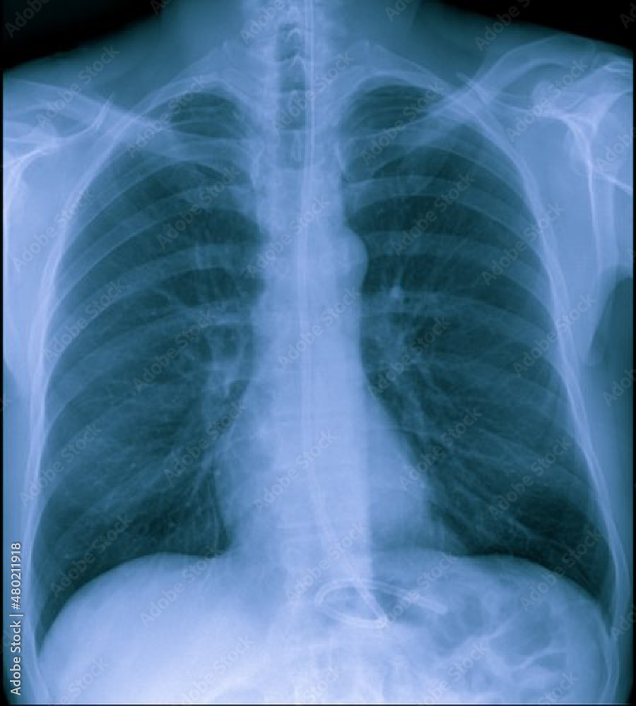 Radiographic image or X-Ray Image of Human Chest Radiographic image or X-Ray Image of Human Chest