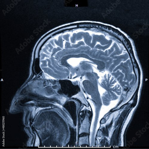 magnetic resonance image (MRI) of the brain - side view image