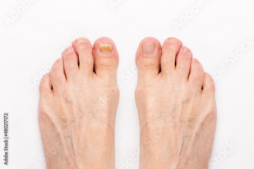 Close-up of a male foot with yellow ugly fungus on toenails and healed nails before and after treatmet isolated on a white background. Fungal nail infection.
Advanced stage of disease. Top view photo