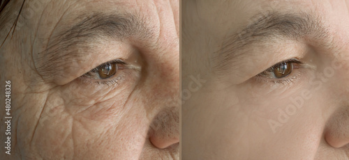 woman face wrinkles before and after treatment