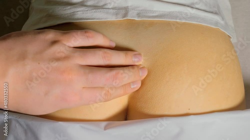 Fracture of the coccyx of spine. External medical exam by a doctor. Gloved hands show trauma. The sacrum and coccyx protrude and are clearly visible.