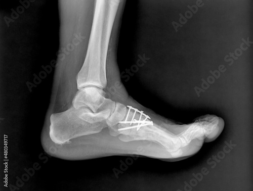 Radiography of a operated foot, after trauma, in lateral-lateral projection