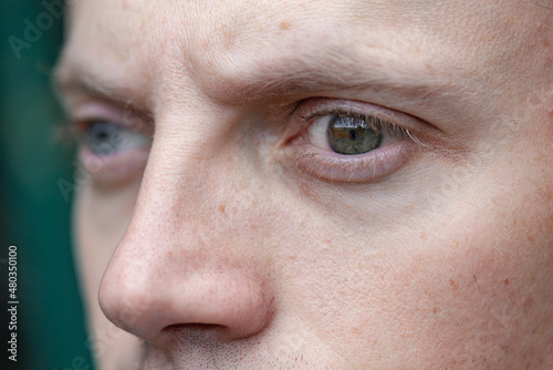 Foto photo in profile of a man with strabismus and blindness of one eye