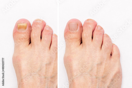 Macro shot of a male foot with yellow ugly fungus on toenails and healthy nails before and after treatmet isolated on a white background. Fungal nail infection. Advanced stage of disease. Top view