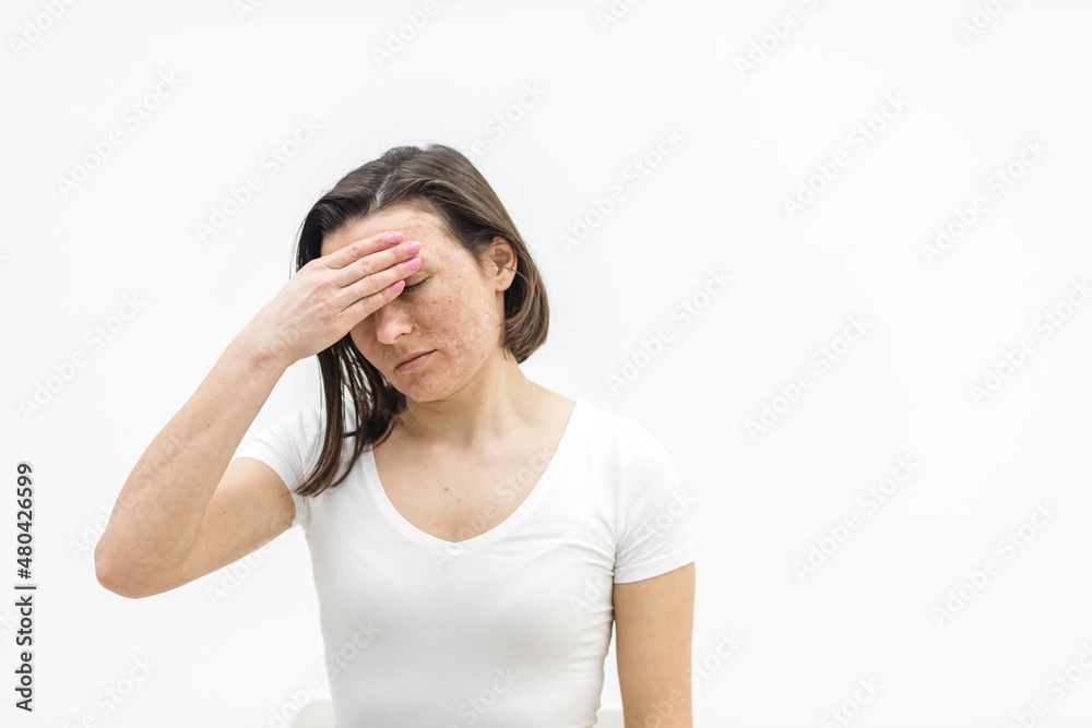 Photo of woman having skin problems and feeling bad because of it. Photo of woman having skin problems and feeling bad because of it.