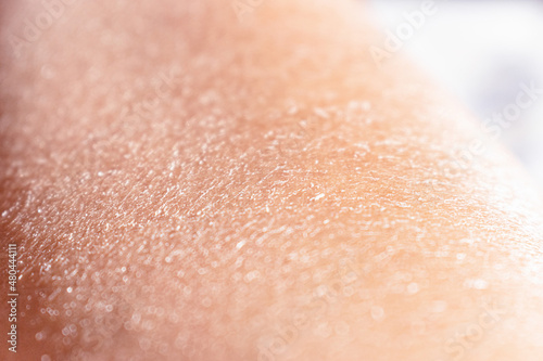 Concept of extremely dry and dehydrated skin of the body. Problematic skin diagnosed with xerosi or dermatitis. Close up of chapped arms and legs. Selective focus of a itchy skin.