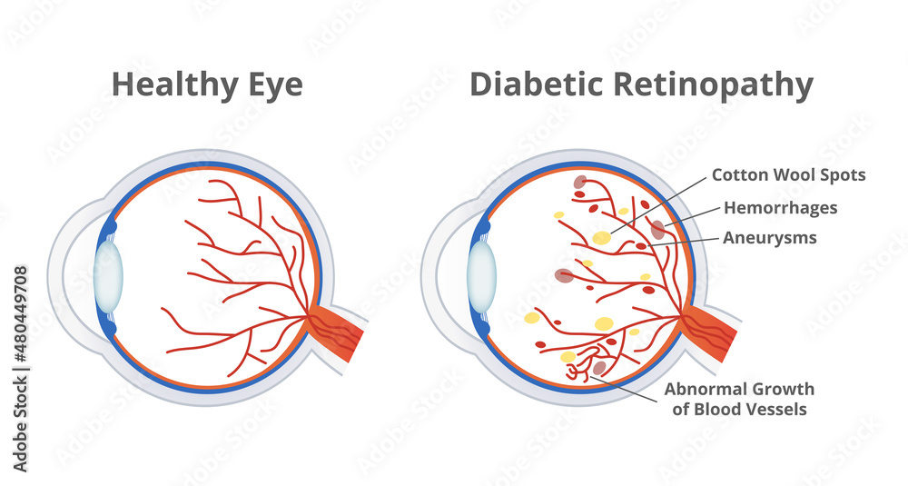 Serene Can Diabetes Affect The Eyes Image Art Serene Can Diabetes Affect The Eyes Image Art